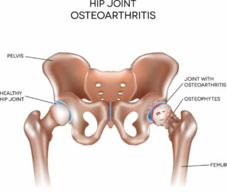 hip joint osteoarthritis